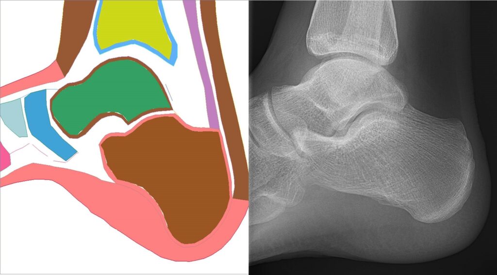 CSRC is assessing, for example, why crash injury differences have been reported between males and females, particularly in the ankle